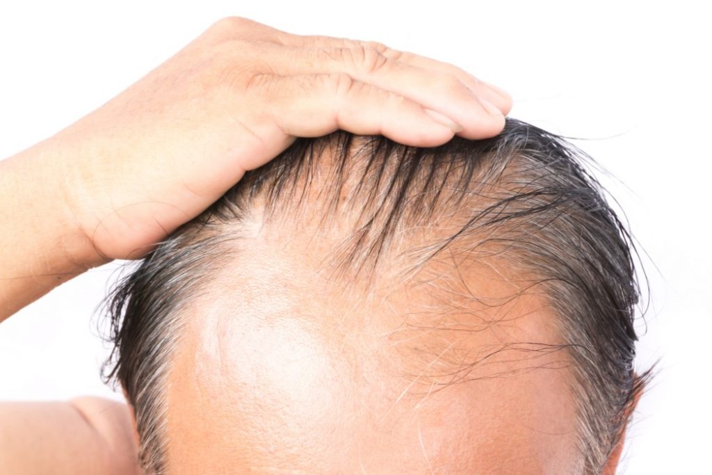 Haarausfall Stirn